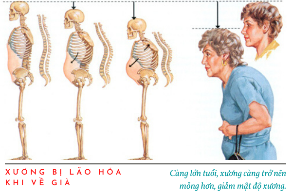 Bệnh loãng xương ở người già, Bệnh loãng xương có nguy hiểm không, Triệu chứng của bệnh loãng xương, Bệnh loãng xương nên ăn gì, Nguyên nhân loãng xương, Thực phẩm chống loãng xương
