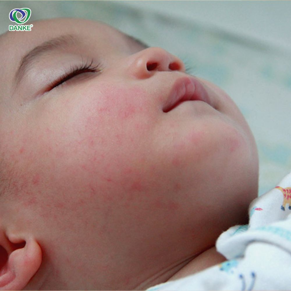Biểu hiện của trẻ bị sốt xuất huyết phát ban 